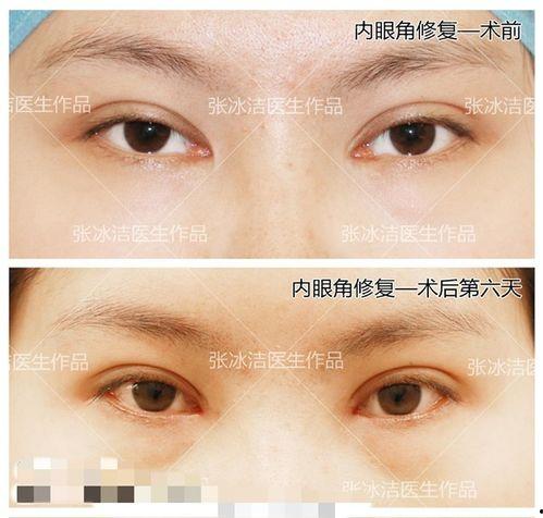 眼角疤痕图片,见证美丽蜕变之旅